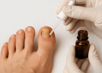 A gloved hand applies antifungal nail treatment with a dropper to a thickened toenail showing signs of toenail fungus. An amber glass bottle rests beside the foot on a clean white surface.