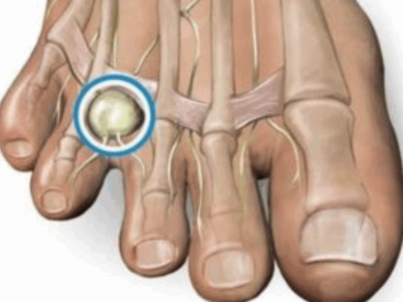 Neuroma