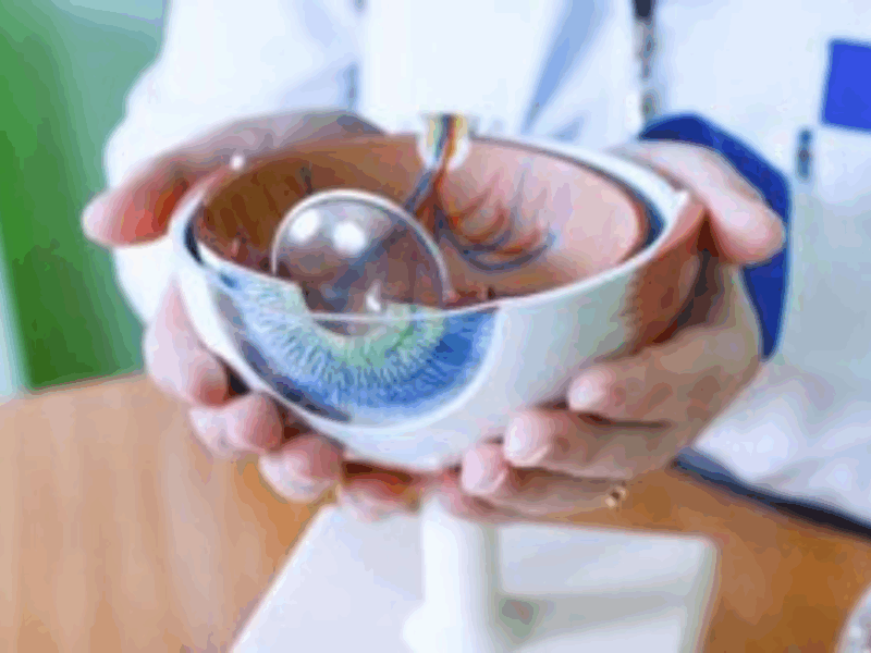 Clear Vision After Cataracts