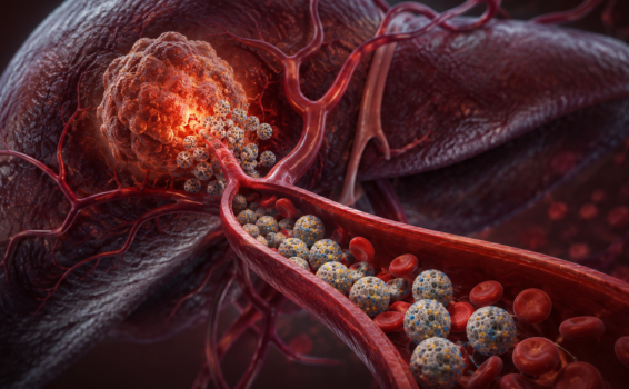 A close-up illustration of a liver tumor with targeted medicine, shown as small spheres, traveling through blood vessels toward the tumor to depict advanced cancer treatment delivery.