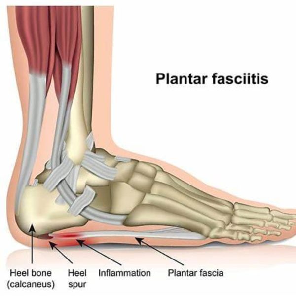Medical Diagram of Plantar Fasciitis Anatomical diagram of the foot showing plantar fasciitis, with labels for the heel bone, heel spur, plantar fascia, and inflammation area.