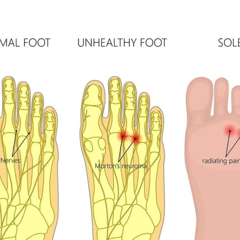 Diagram of Normal vs. Affected Foot Diagram of Normal vs. Affected Foot