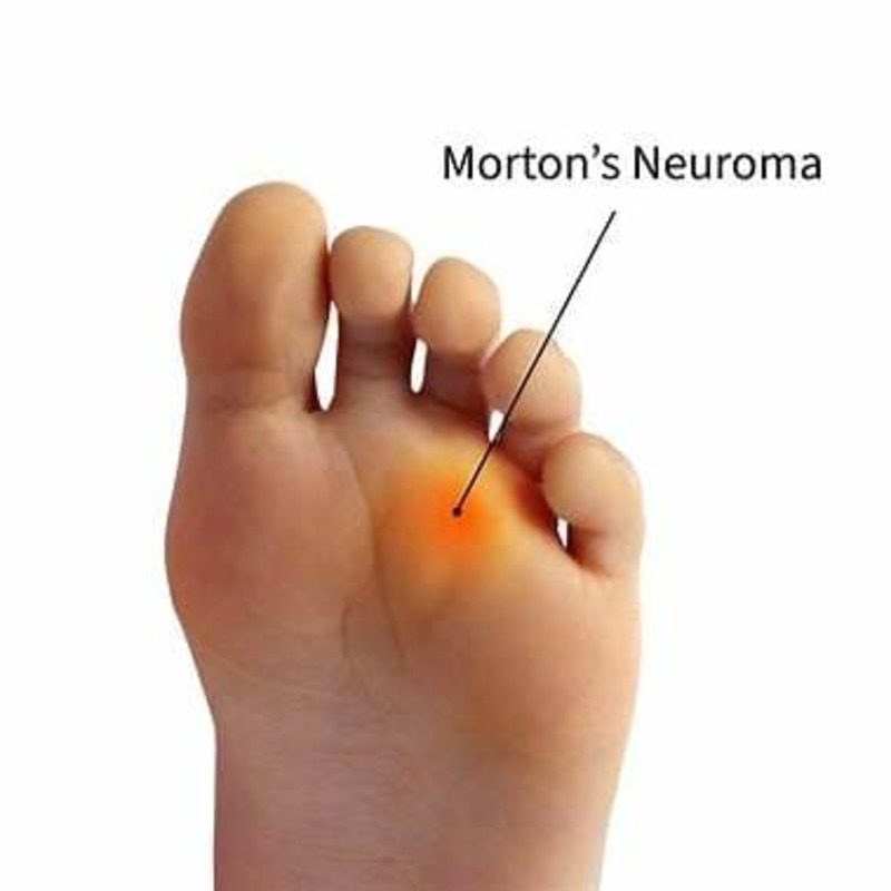 Location of Morton’s Neuroma Bottom view of a foot with a red-highlighted area between the third and fourth toes, labeled as Morton’s neuroma.